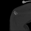 SPORK, NICO - 22.03.1976 - 02.08.2022 - CT obere Extremität - 17:59:07